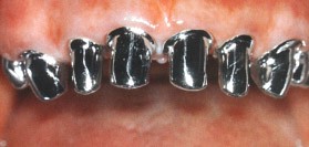 PROTESIS FIJA METAL PORCELANA VITA