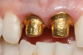 RESTAURACIONES COLADAS EN ORO